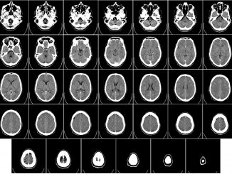 cerebro 1